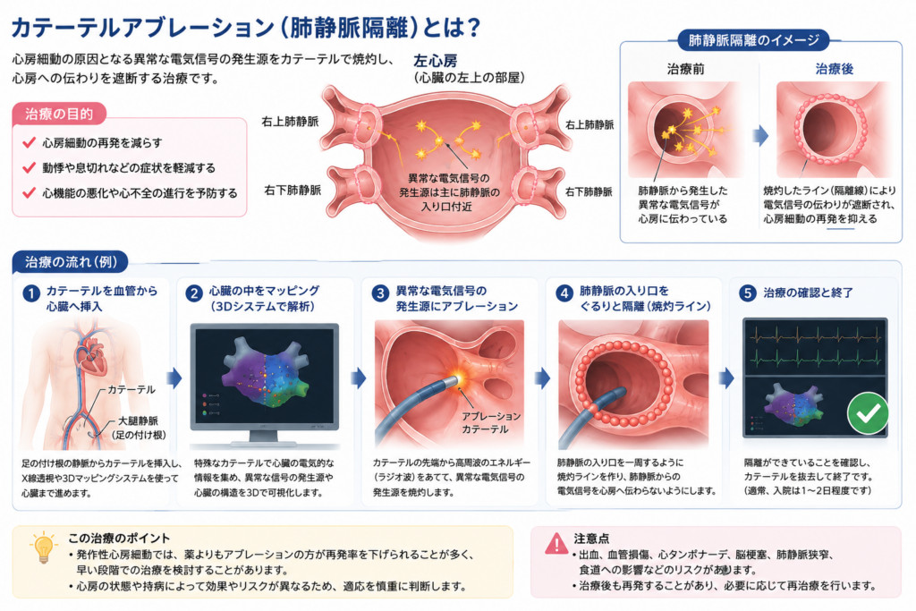 カテーテルアブレーション(肺静脈隔離)を説明するインフォグラフィック。左心房で肺静脈から発生する異常な電気信号と、焼灼による隔離ラインで信号の伝わりを遮断する仕組み、①カテーテル挿入②心臓のマッピング③異常信号源へのアブレーション④肺静脈入口の焼灼隔離⑤治療の確認と終了という治療の流れ、および治療のポイントと出血・血管損傷・心タンポナーデ・脳梗塞・肺静脈狭窄などの注意点をまとめている